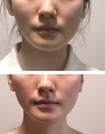 顎変形症手術 顔の変化　10年経過　施術前後